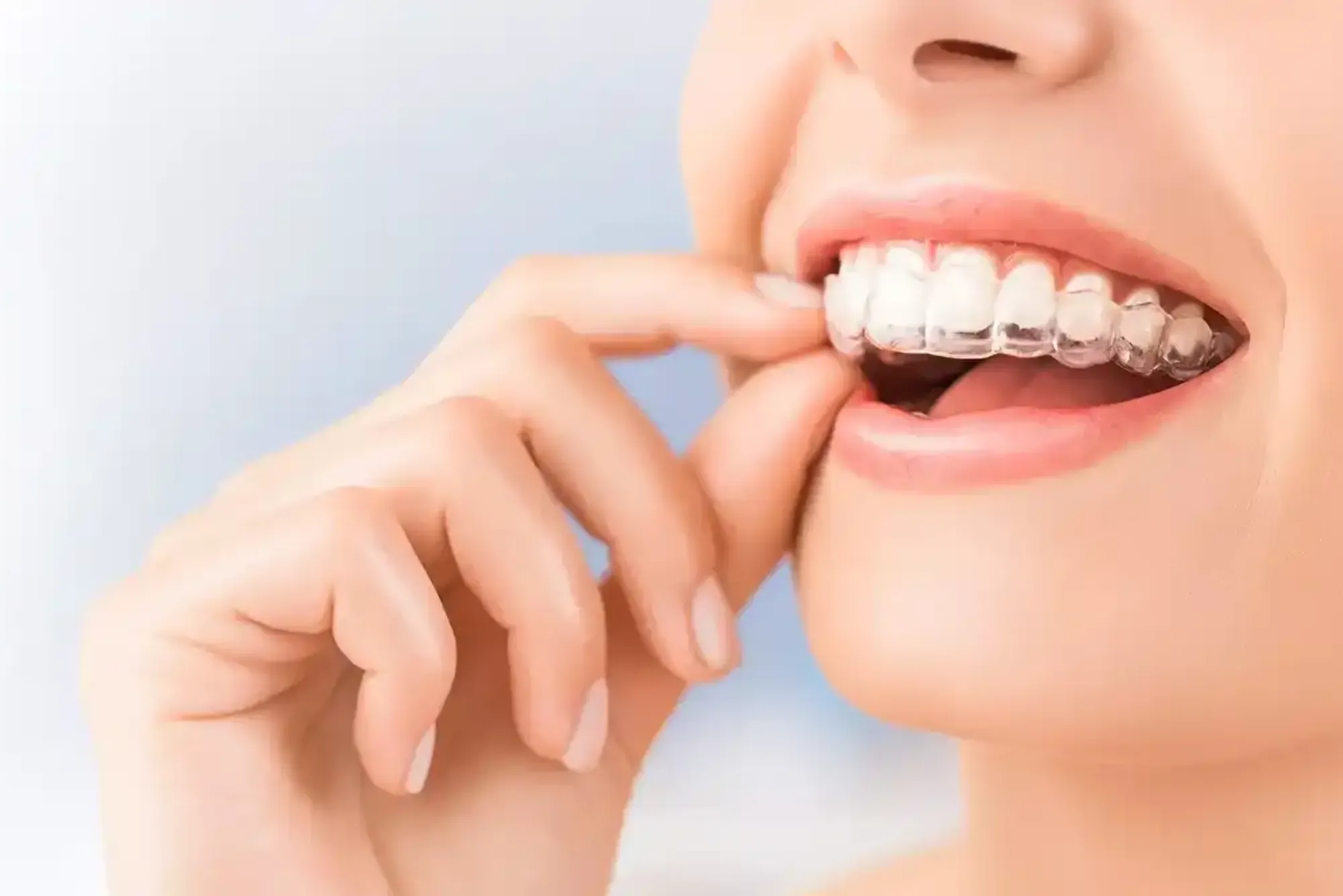 Best Dentist In Dubai To Get Invisalign